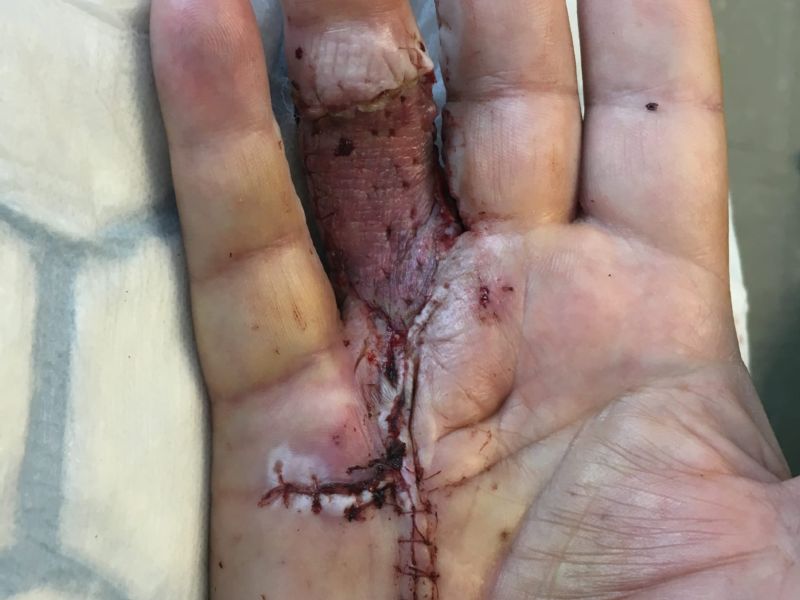 Hand affected by Dupuytren's disease, shown seven days after the Dermofasciectomy during dressing change